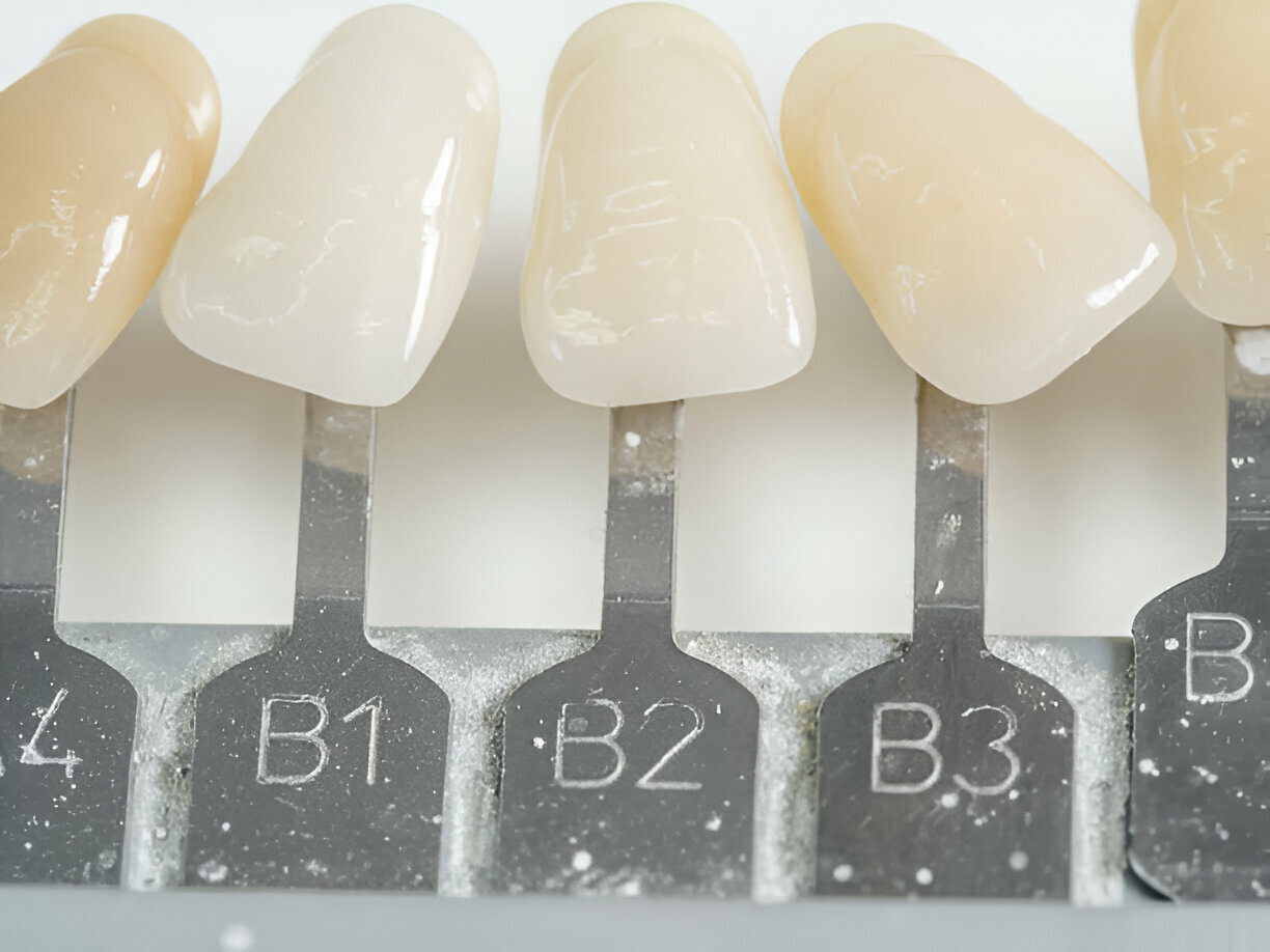 The Role of Silver Diamine Fluoride in Preventing Cavities in Children