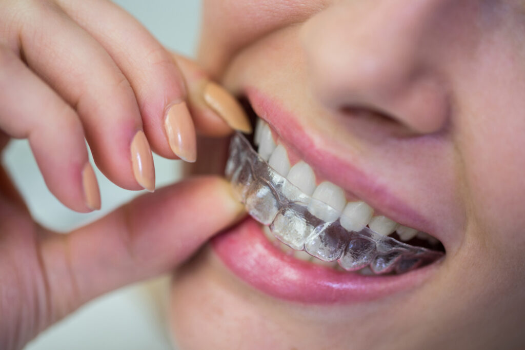 Clear Aligner Treatment