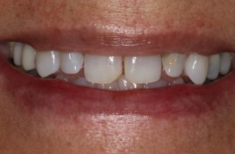 MK before
