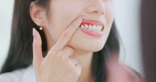 Kraner Family Dentistry | How to Spot Early Signs of Gum Disease (Before It Gets Worse)